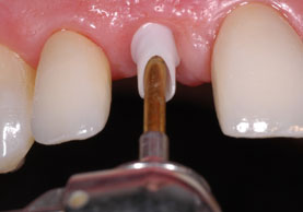 IMPLANT WITH AESTHETIC ABUTMENT