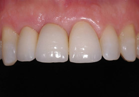 FINAL RESULT WITH NOBEL ACTIVE IMPLANT OF FUTURE