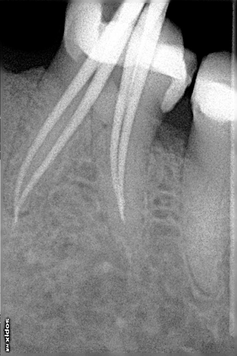X-RAY FOR CONFIRMATION OF WORKING LENGTH