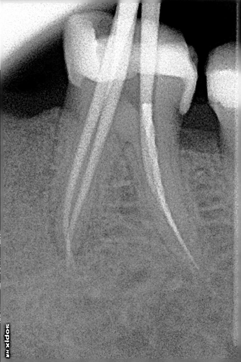 FULL WORKING LENGTH ACHIEVED FOR FINAL OBTURATION