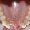 Palatal view of missing teeth