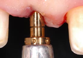 NOBEL ACTIVE DENTAL IMPLANT PLACED SAFELY