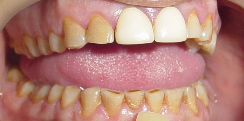 Badly stained teeth