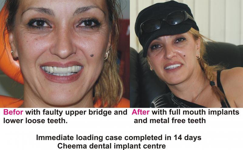 Volet from USA, done immediate loading full mouth implants.